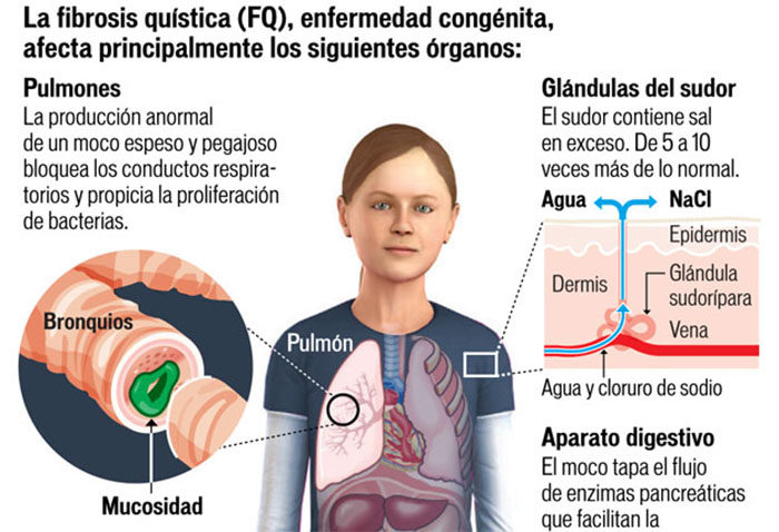 fibrosis quística niños